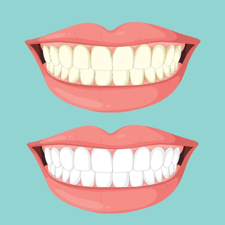 before after teeth whitening 1308 178565