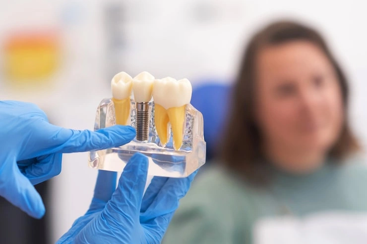 dental implants dentist discussing treatment plan with patient holds dental implant model 210545 2101