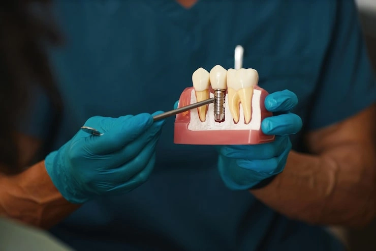 illustrating dental implant procedure model 274689 57184