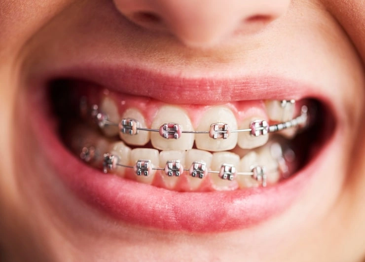 shot child s teeth with braces 329181 17722
