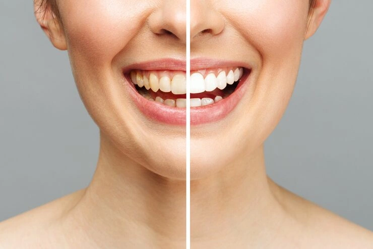 woman teeth before after whitening white background dental clinic patient image symbolizes oral care dentistry stomatology 168410 1716