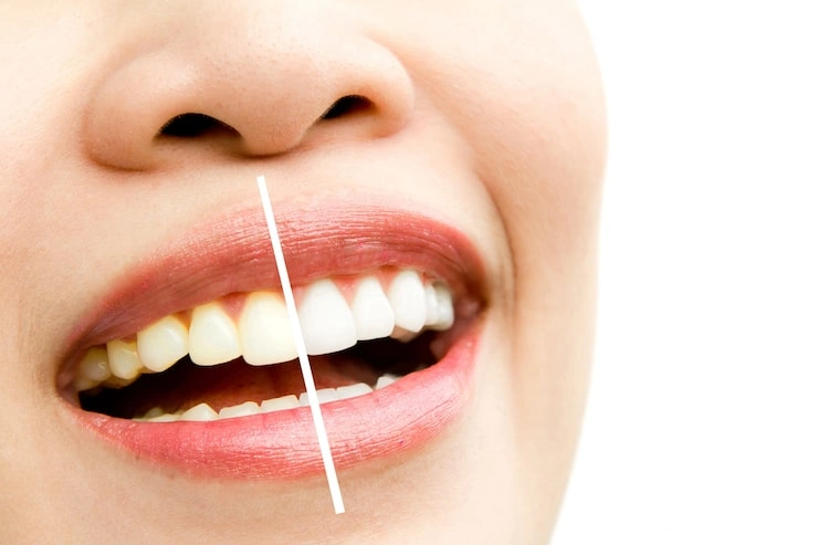 woman whitening treatment 1232 185